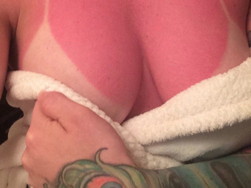 Burn on the Fourth of July - Red Sunburned Boobs - Ouch!